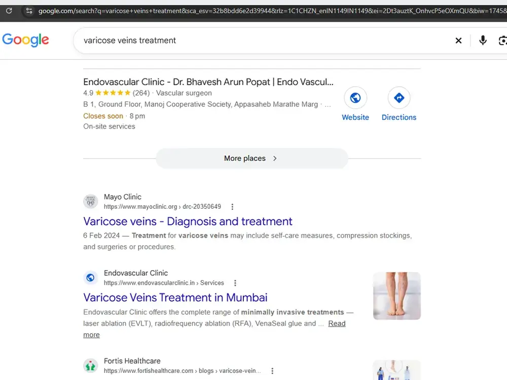 Google results for “varicose veins treatment”: the Endovascular Clinic business listing at the top, rated 4.9 from 264 reviews, with the clinic’s own treatment page ranking in the organic results above Fortis Healthcare.