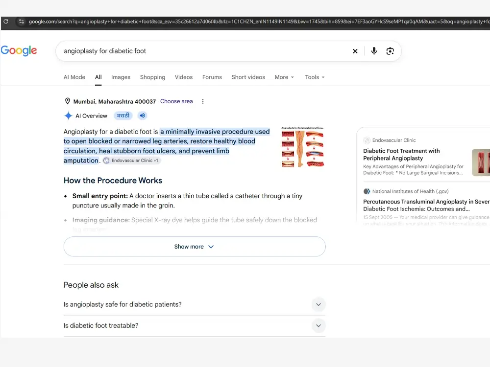 Google results for “angioplasty for diabetic foot”: the AI Overview cites Endovascular Clinic as a source, and the clinic’s diabetic-foot page appears alongside the National Institutes of Health.