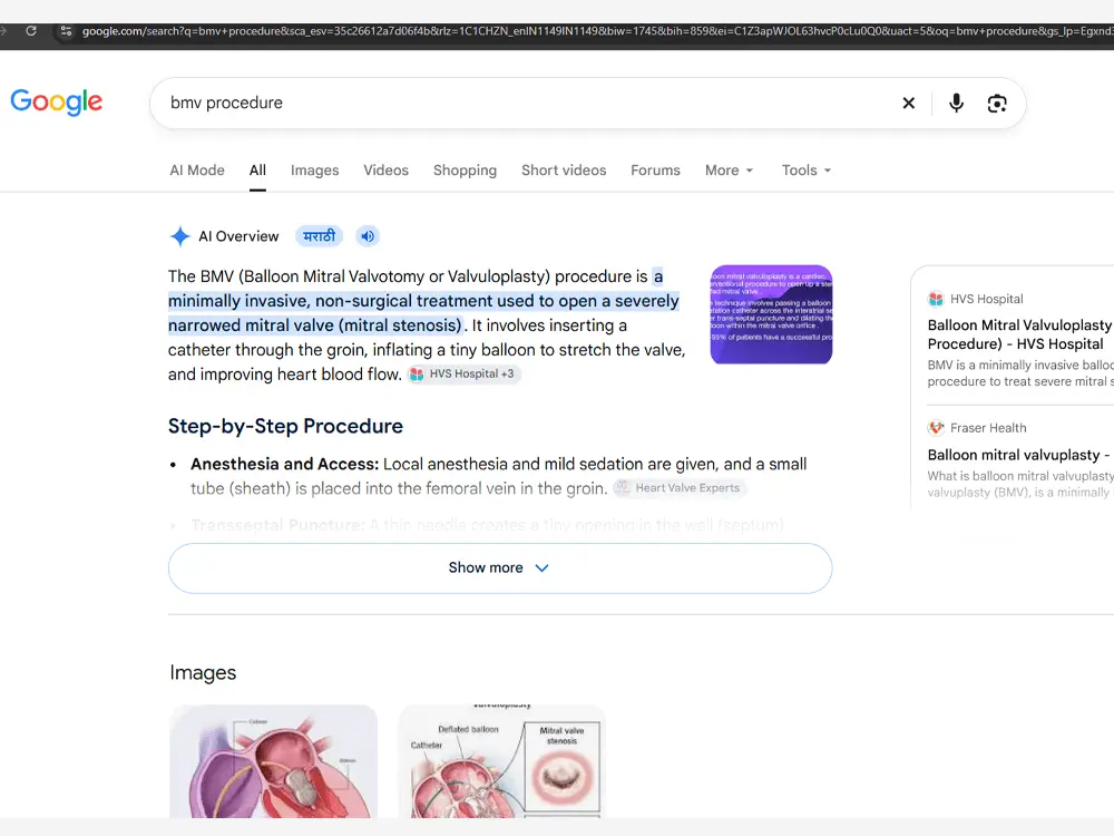 Google results for “bmv procedure”: the AI Overview cites HVS Hospital as a source, and the hospital’s balloon mitral valvuloplasty page is listed above Fraser Health.